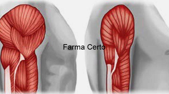 sarcopenia