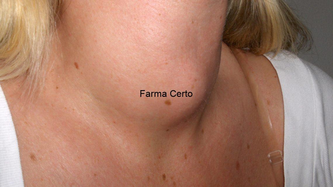 hipertireoidismo